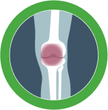Sintomas Artrite Psoriásica